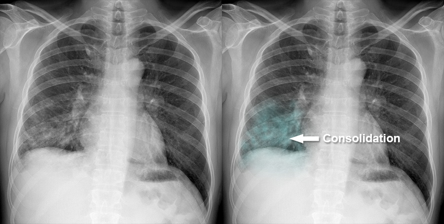 Chest X Ray Consolidation Chest X Ray Consolidation