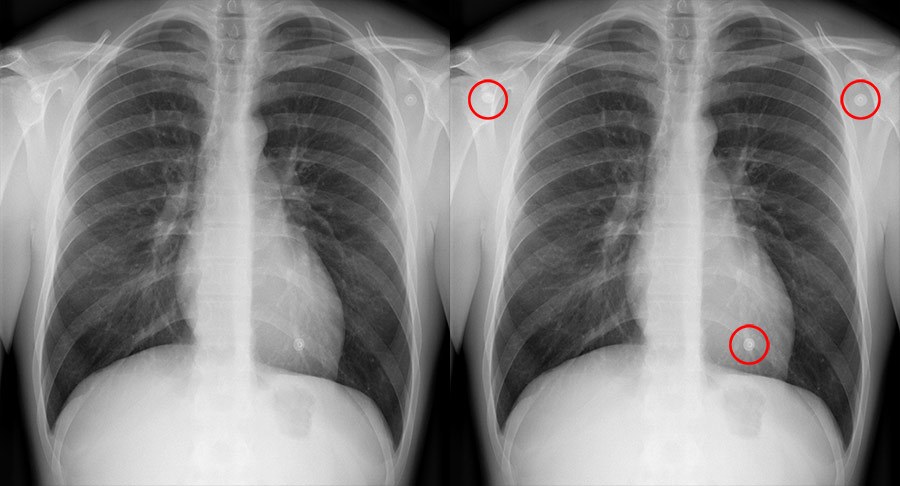Chest X Ray Artifacts