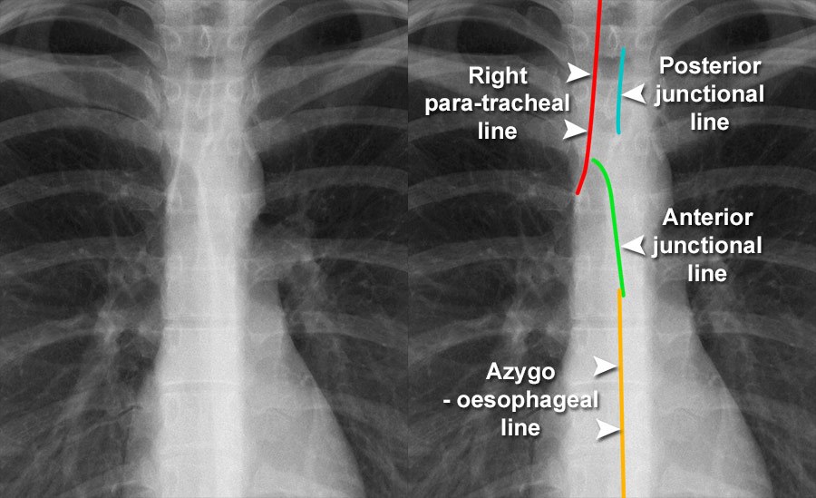 Chest Xray Quality Normal chest Xray detail