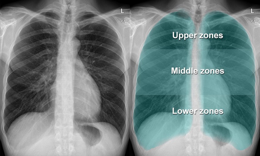 Chest Xray Quality Normal chest Xray lung zones