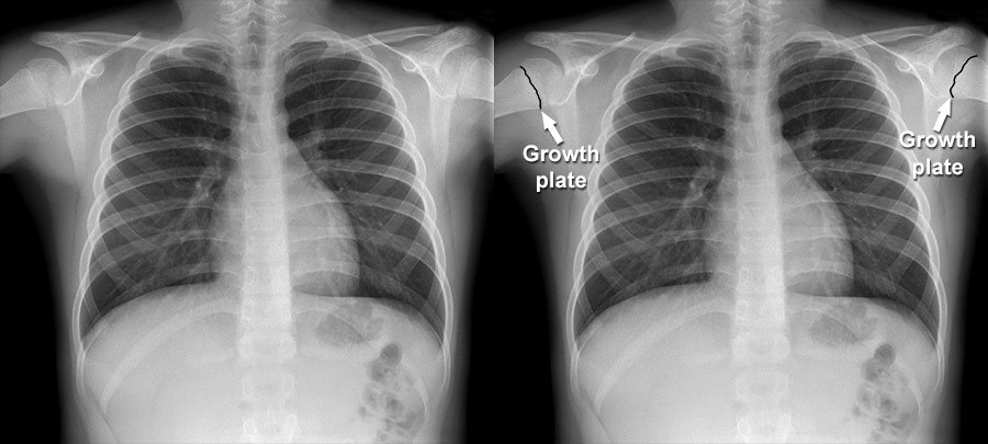 Normal Chest X Ray Images