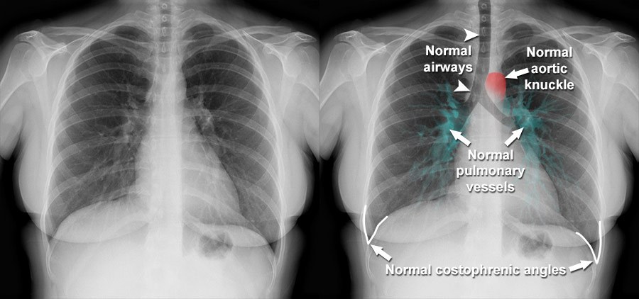 Normal Chest X Ray Labeled normal-chest-x-ray-labeled