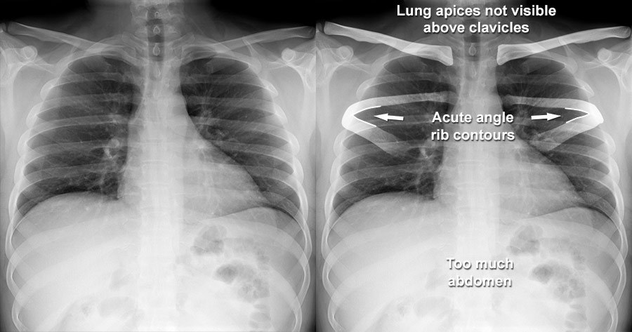 normal chest xray labeled