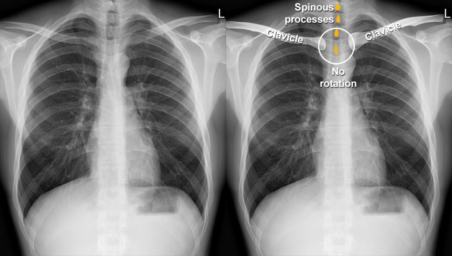 normal chest xray labeled