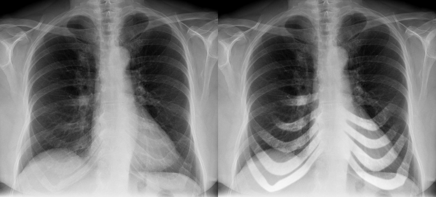 Costochondritis X Ray costochondritis-x-ray