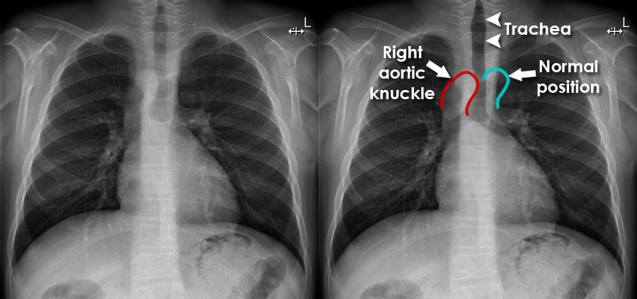 Aortic Arch Chest X Ray