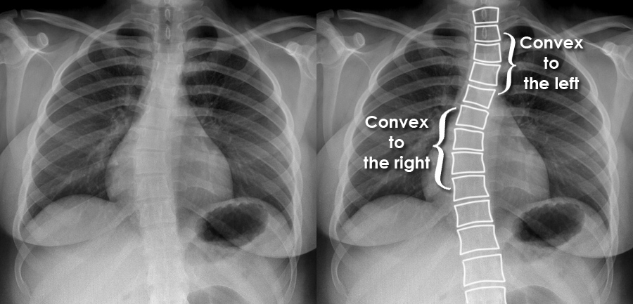 mild scoliosis x ray