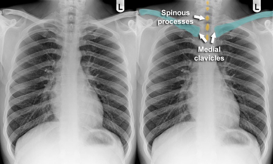 Chest X Ray Rotation