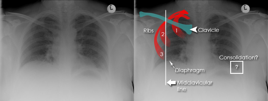 Hyperinflation Chest X Ray average-chest-circumference-cm-s-d-download-table