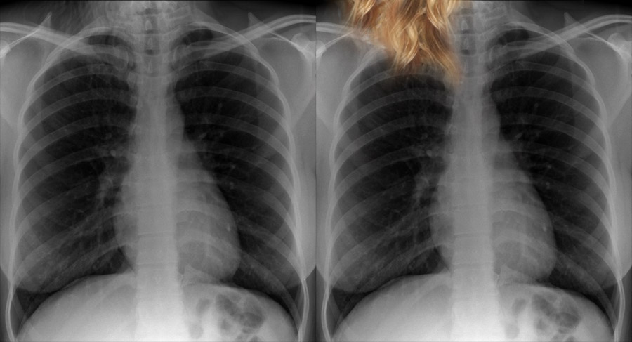 Chest X-ray Quality - Artifact