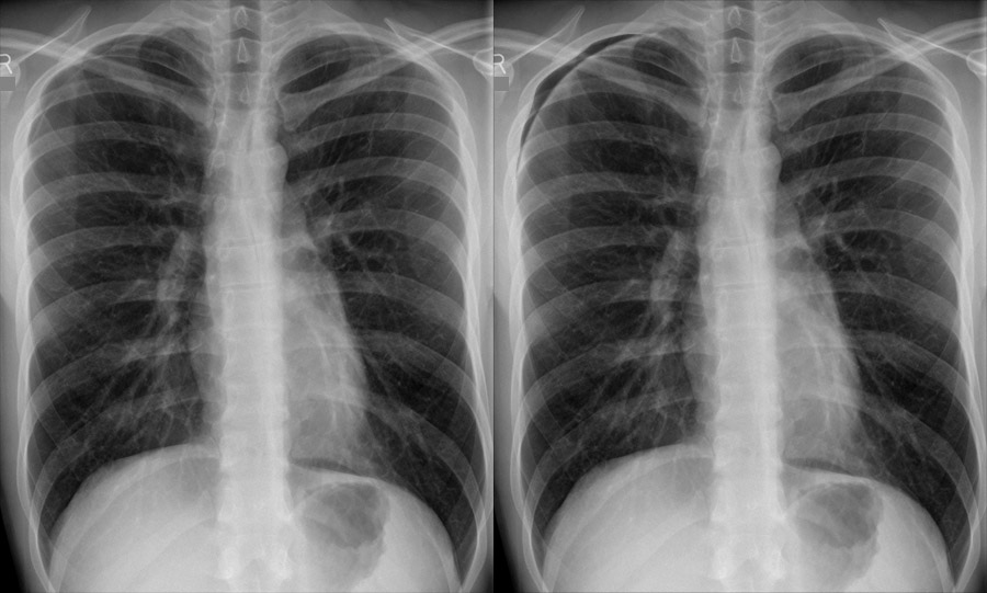 Chest Xray Systematic Approach Review areas