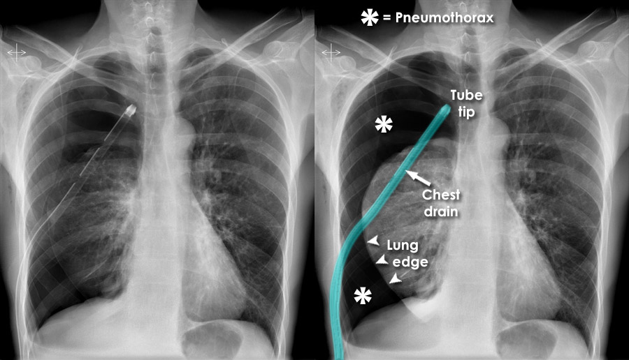 Chest X ray Tubes Chest Drains Position chest-x-ray-tubes-chest-drains-position