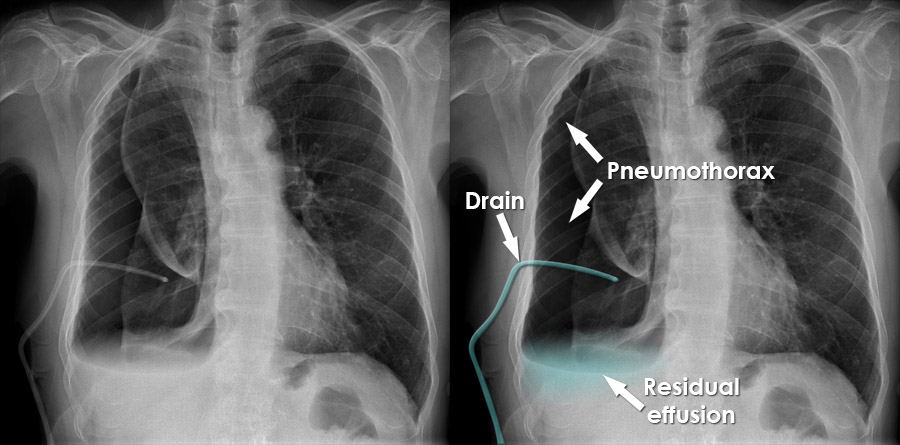 pneumothorax chest tube