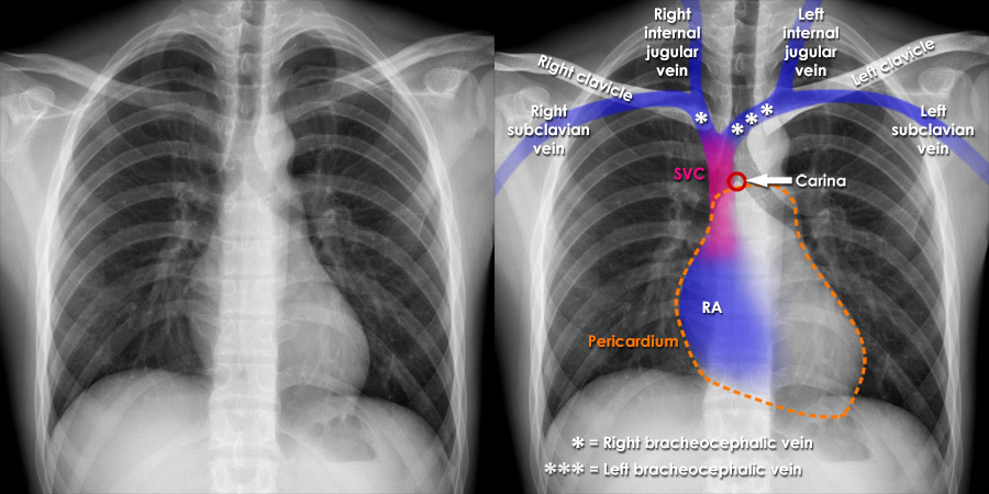 picc in innominate vein