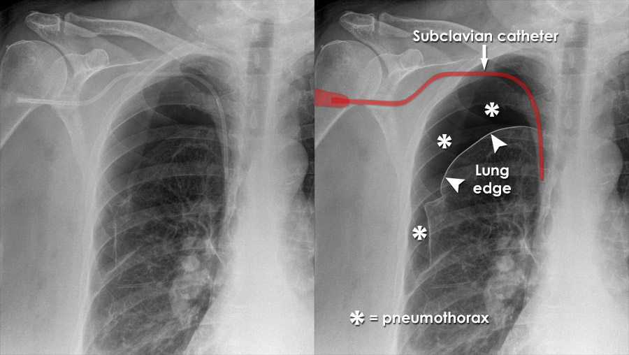 picc in innominate vein