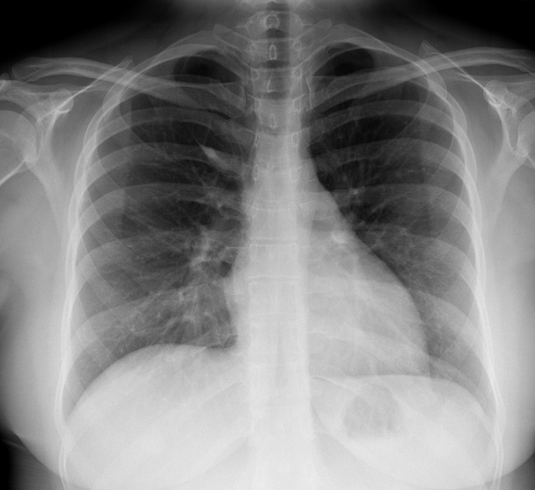 Chest X Ray Test chest-x-ray-test