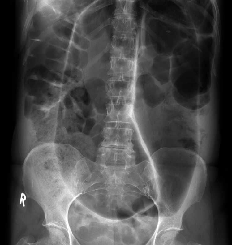 Radiology Masterclass Test Yourself Abdominal Xray Quiz