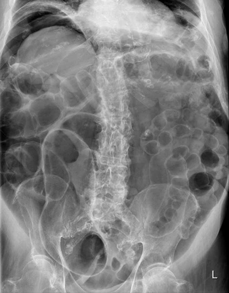 Radiology Masterclass Test Yourself Abdominal Xray Quiz