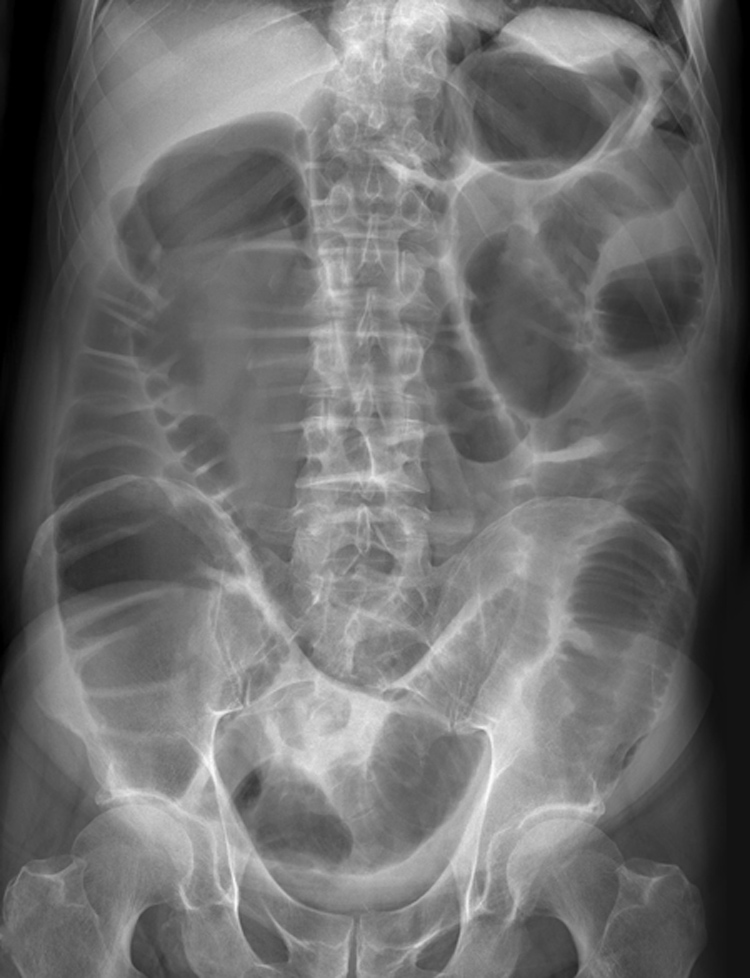 Инородное тело брюшной полости после операции. Спаечная непроходимость рентген. Рентген тонкокишечной непроходимости. Парез кишечника рентген. Кишечная непроходимость тонкокишечная.