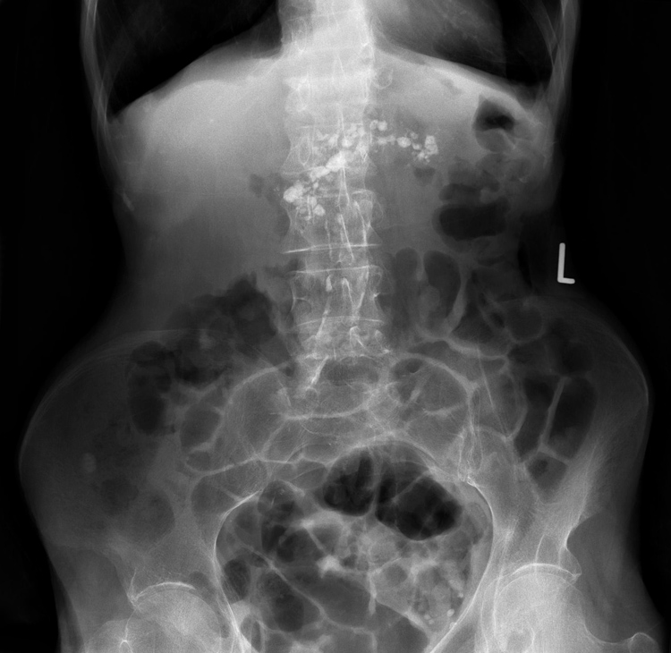 Radiology Masterclass Test Yourself Abdominal Xray Quiz