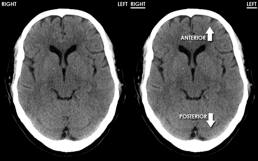 Anatomy Of Brain Ct Scan Anatomy Drawing Diagram Imag - vrogue.co