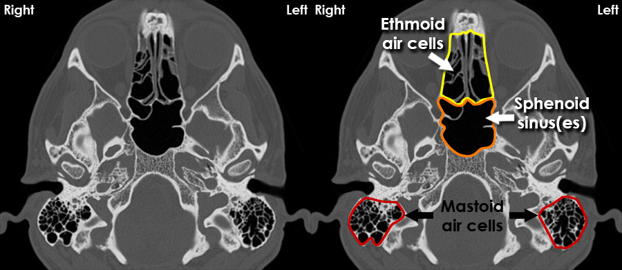 ct scan sinus paranasal