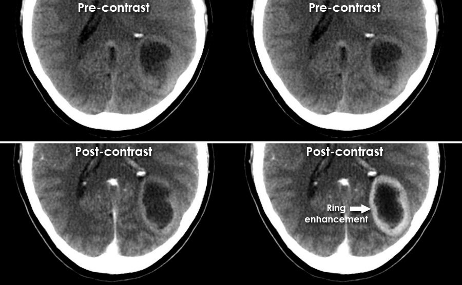 A rare cause of temporal lobe ring-enhancing lesion | Neurology Clinical  Practice