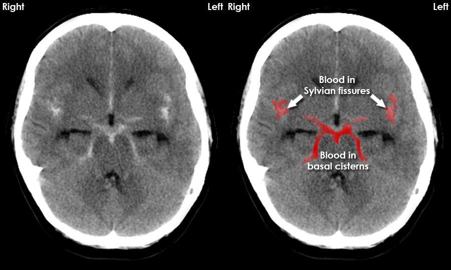 Subarachnoid Hemorrhage - What You Need to Know