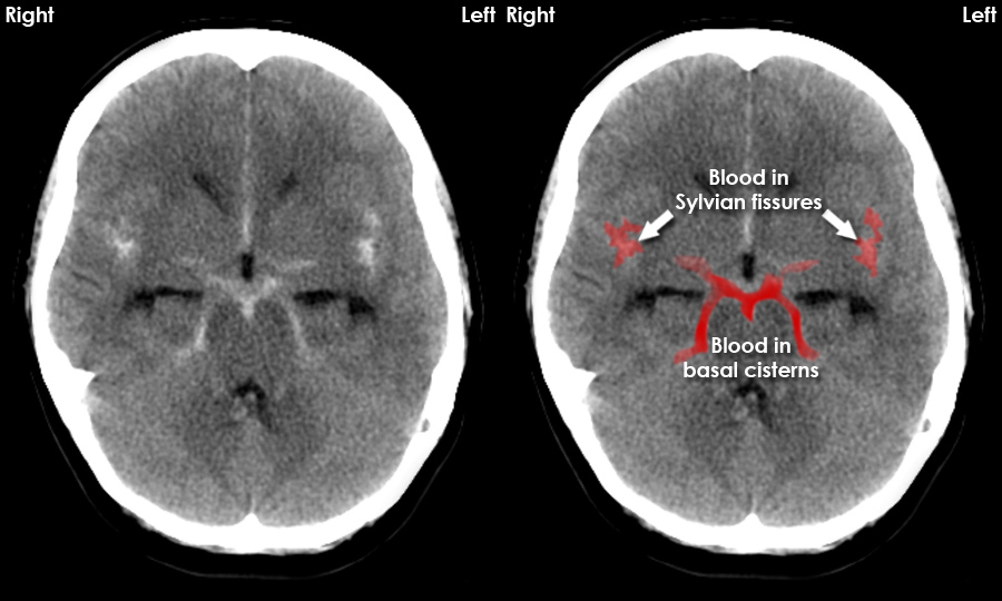 CT brain image gallery - SAH