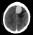 CT Brain - Scroll image gallery - Normal ventricles