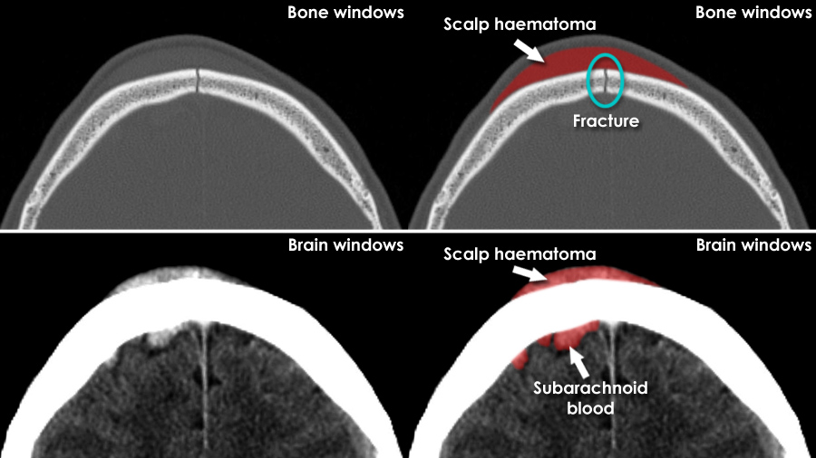Acute CT Brain Scalp and skull injury