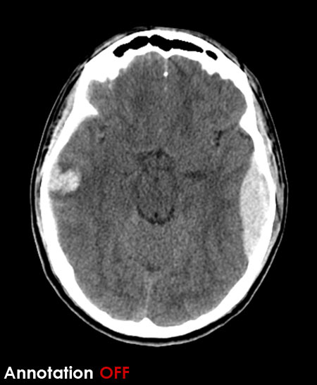 CT brain - extradural haemorrhage