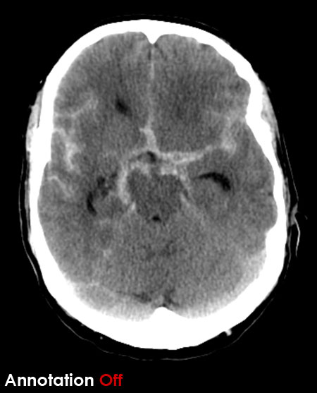 CT brain - subarachnoid haemorrhage