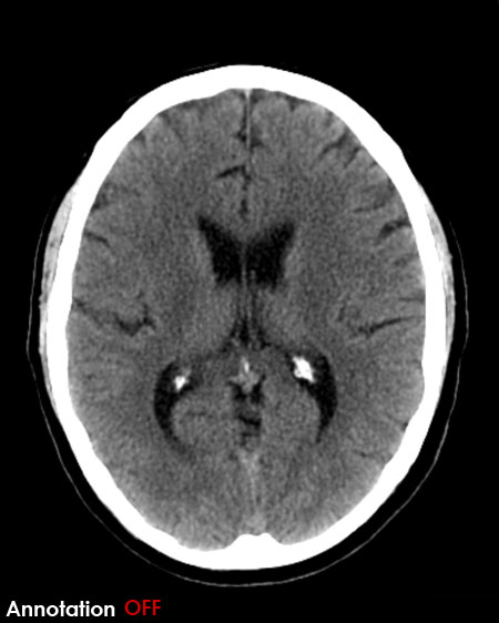 CT brain - ventricles