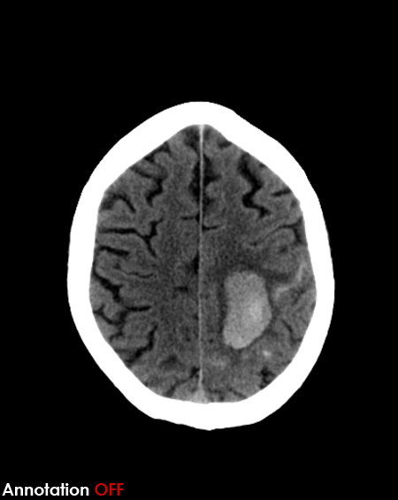 CT brain - intracebral haemorrhage