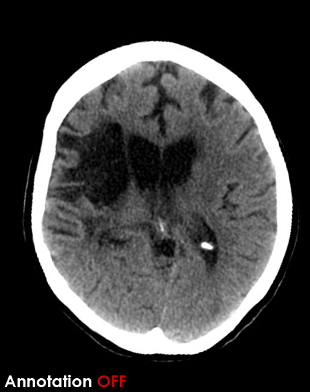 CT brain - old MCA infarct