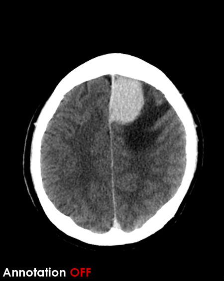 CT brain - meningioma