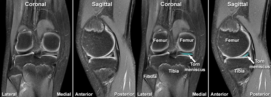 MRI Gallery - MRI Knee - Meniscal tears