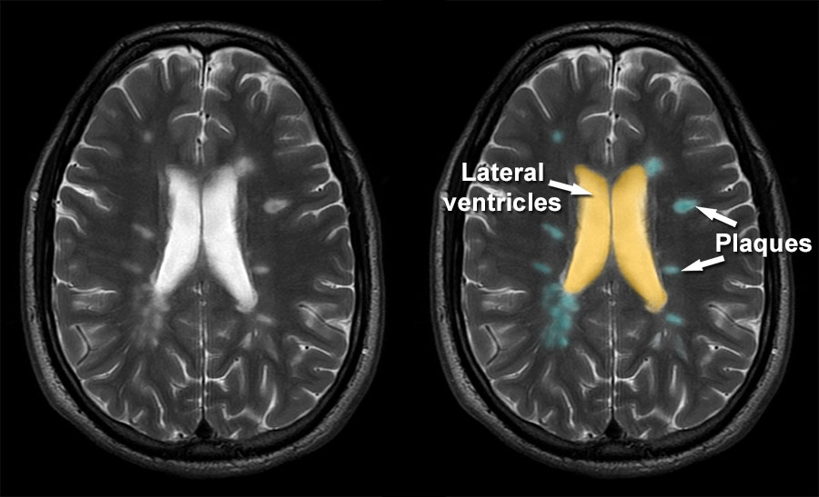 ms mri brain scan results