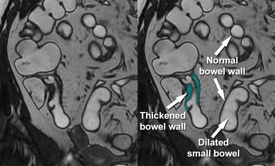MRI Gallery MRI Small Bowel Crohn's