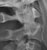 c-spine_c2_fracture_thumb.jpg