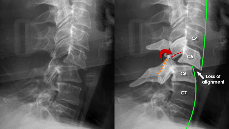 dislocated neck x ray