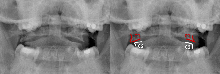 Trauma X-ray - Axial skeleton gallery 1 - Cervical spine - C1/Jefferson  fracture