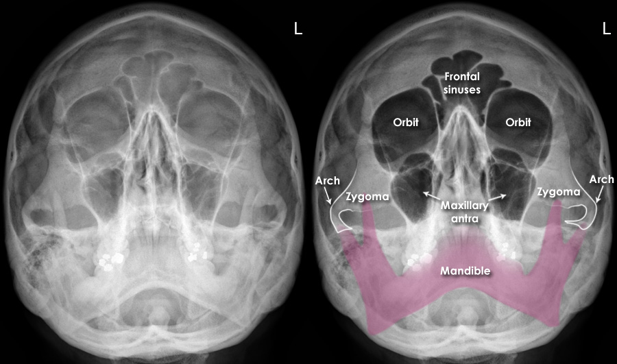 Trauma Xray Axial skeleton gallery 1 Facial bones Normal anatomy