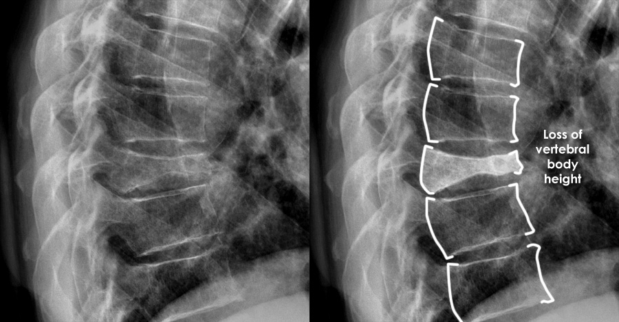 Wedge In Spine wedge-in-spine