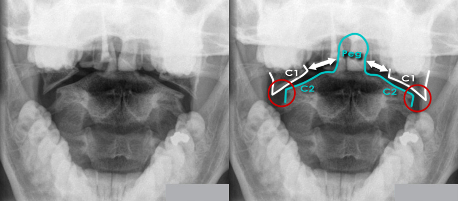 Odontoid and hangman fracture