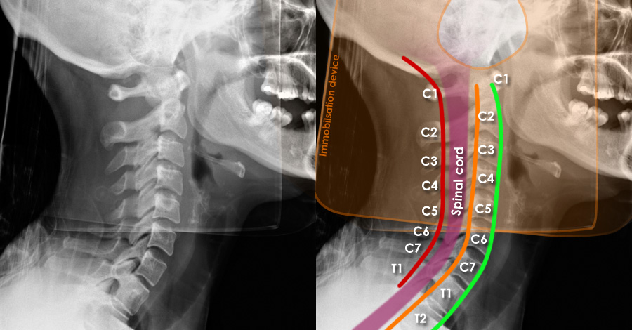 dislocated neck x ray