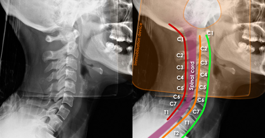 Cervical Spine Normal X Ray Cervical Spine X Ray Diagram NECJN Cervical Spine Normal X Ray Cervical Spine X Ray Diagram NECJN