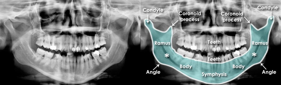 Trauma X Ray Axial Skeleton Mandible