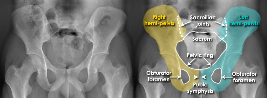 sacrum anatomy xray